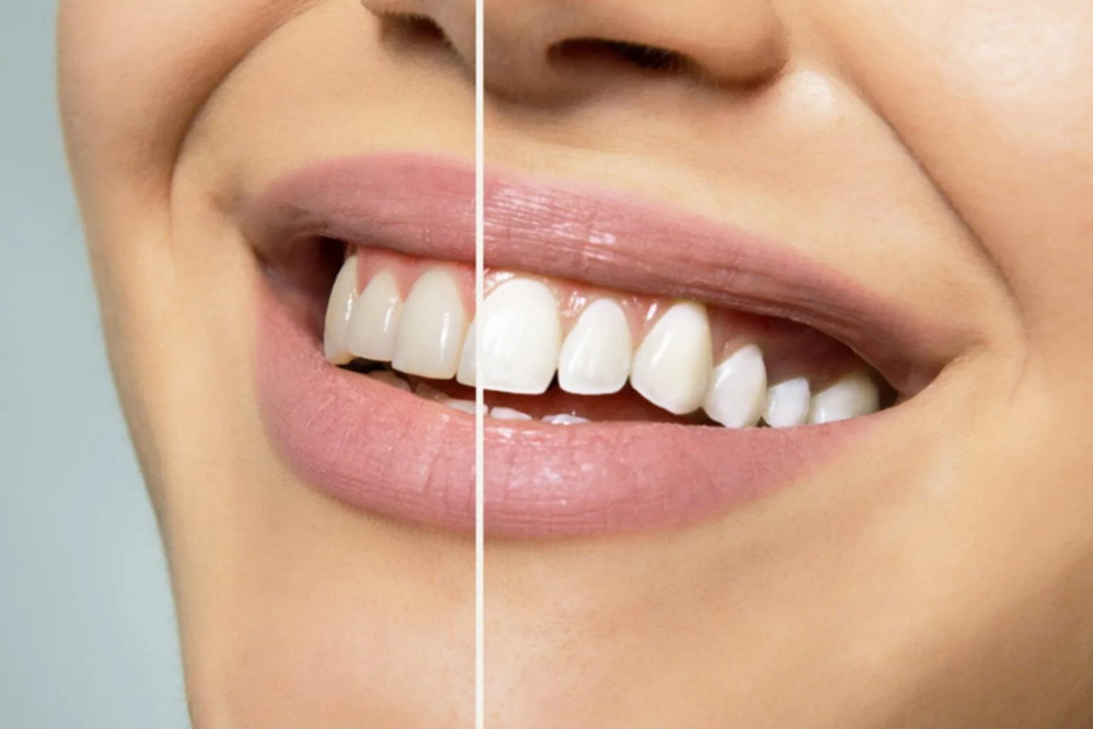 Teeth Whitening